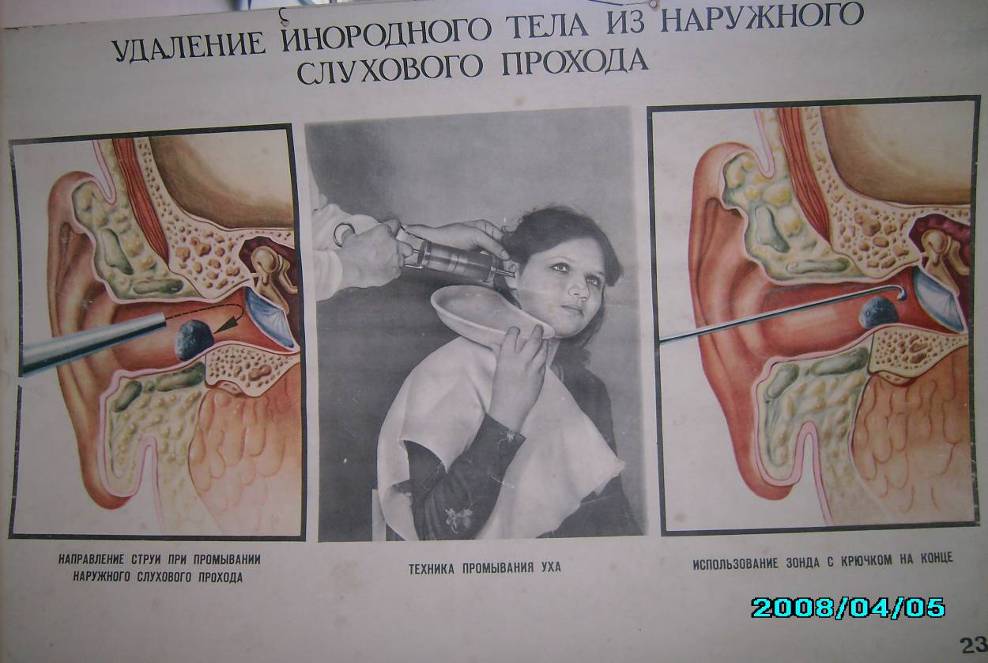 Как достать инородное тело из уха на домашних условиях Как достать инородное тело из уха на домашних условиях