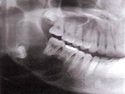 Реферат: Радикулярная зубосодержащая киста