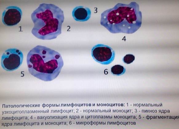 Вакуолизация цитоплазмы моноцитов что это