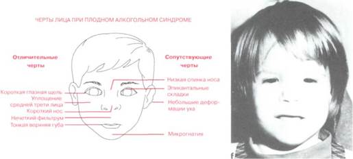 Артрит черепно лицевого сустава. Артрит челюстно-лицевого сустава: симптомы и лечение, причины, что это. Артрит симптомы причины методы лечения Характерные признаки артрита челюстно-лицевого сустава и варианты.