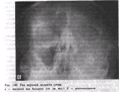 Рак дна полости рта прогноз