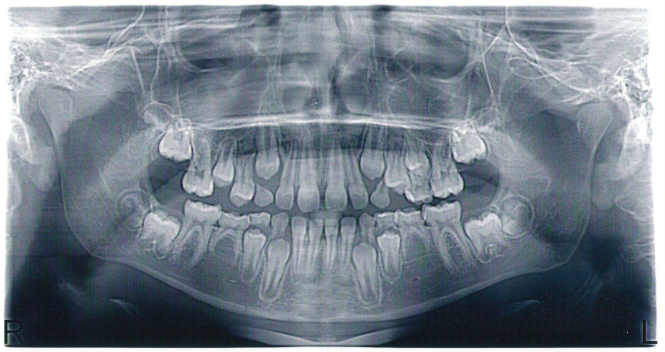 Оптг Зубных Рядов Фото — Картинки фотографии
