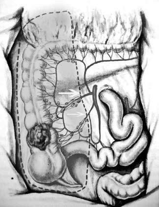 операция слепой кишки. лимфоузлы ободочной кишки. операция левосторонняя гемиколэктомия. операция слепой кишки. спайки сигмовидной кишки.