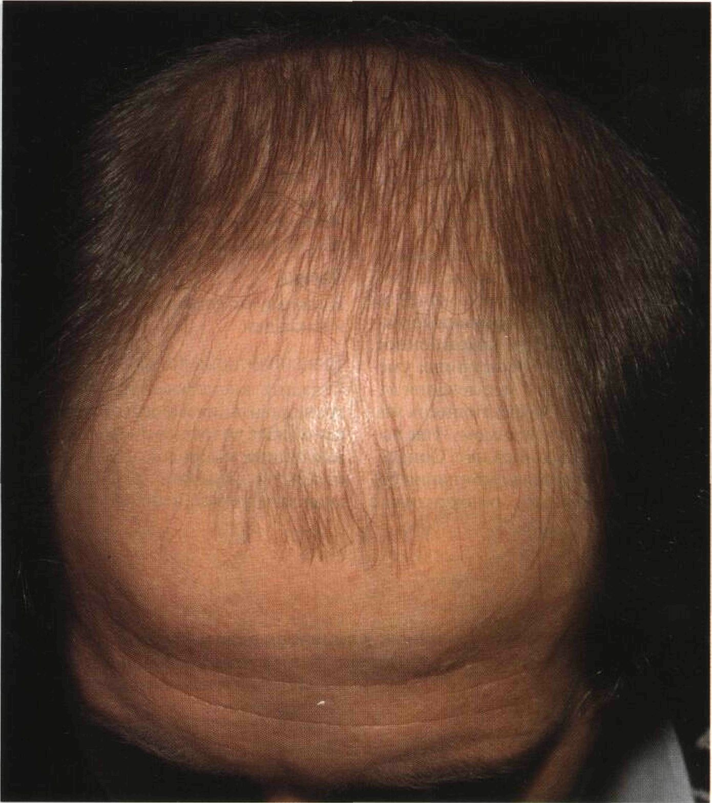 Почему плохо растут волосы на голове. Андрогензависимая алопеция. Андрогенетическая диффузная алопеция. Экозависимая алопеция.