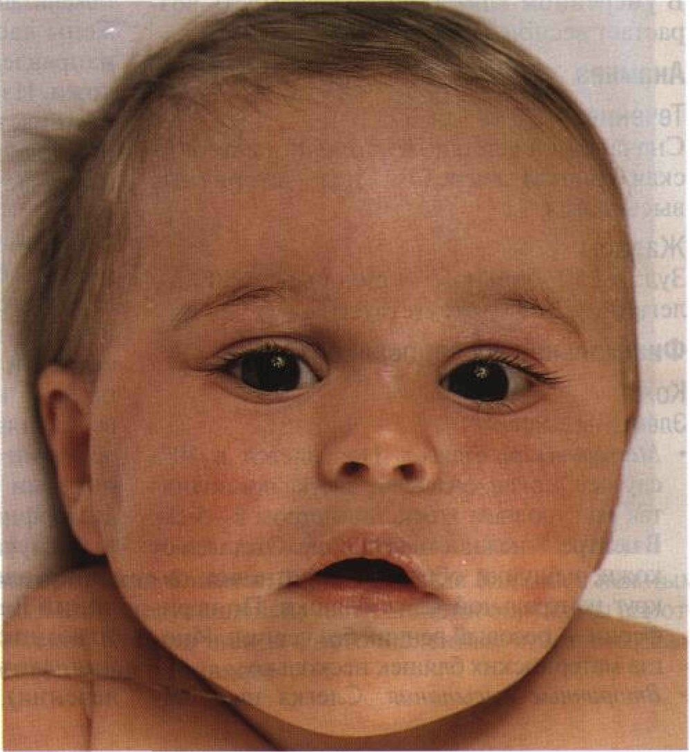 Врожденный птоз. Ламеллярный ихтиоз новорожденных. Асимметрия век у ребенка.