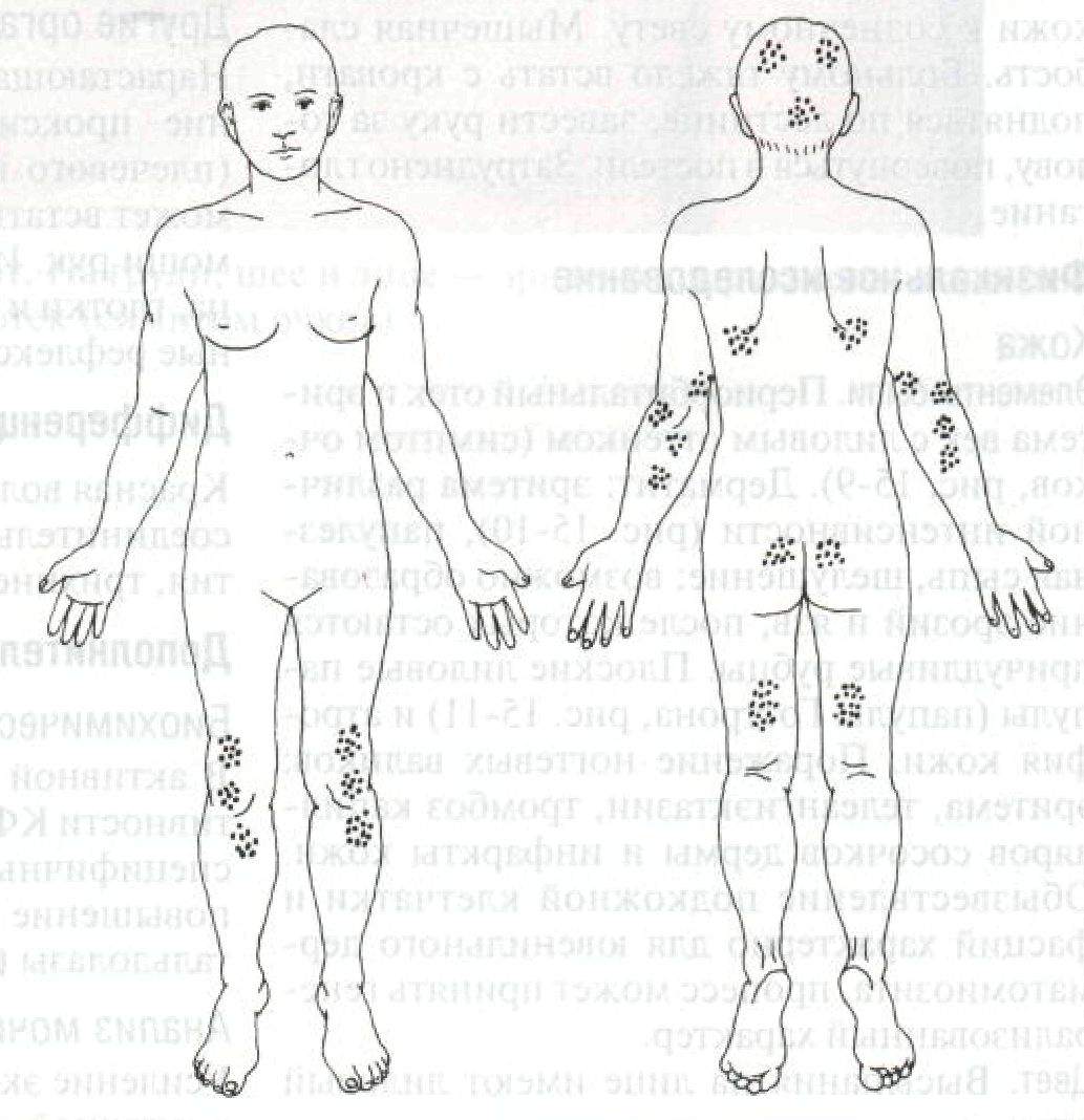 Дерматит Дюринга локализация