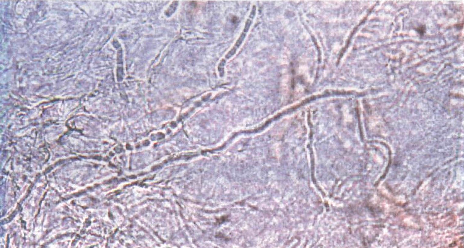 На коже обнаружены споры. Микроскопия Trichophyton rubrum. Мицелий гриба микроскопия. Микоз кожи микроскопия.