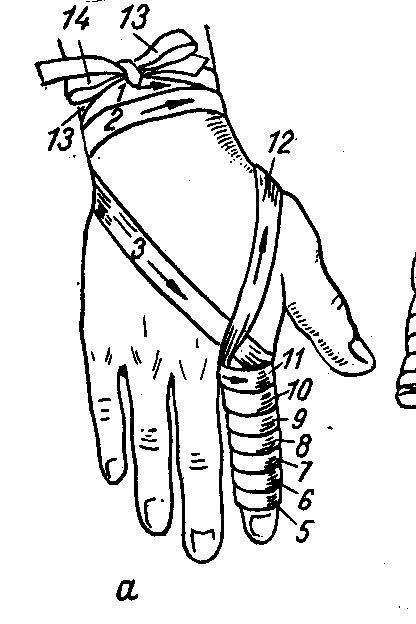 Повязка на стопу и голеностопный сустав (восьмиобразная, бинтовая, косыночная), техника наложения