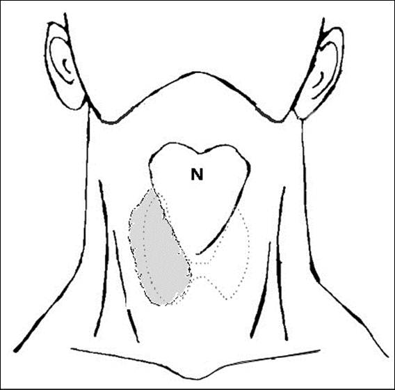 Аплазия щитовидной железы. Аплазия доли щитовидной железы. Агенезия (аплазия) щитовидной железы. Врожденная аплазия щитовидной.