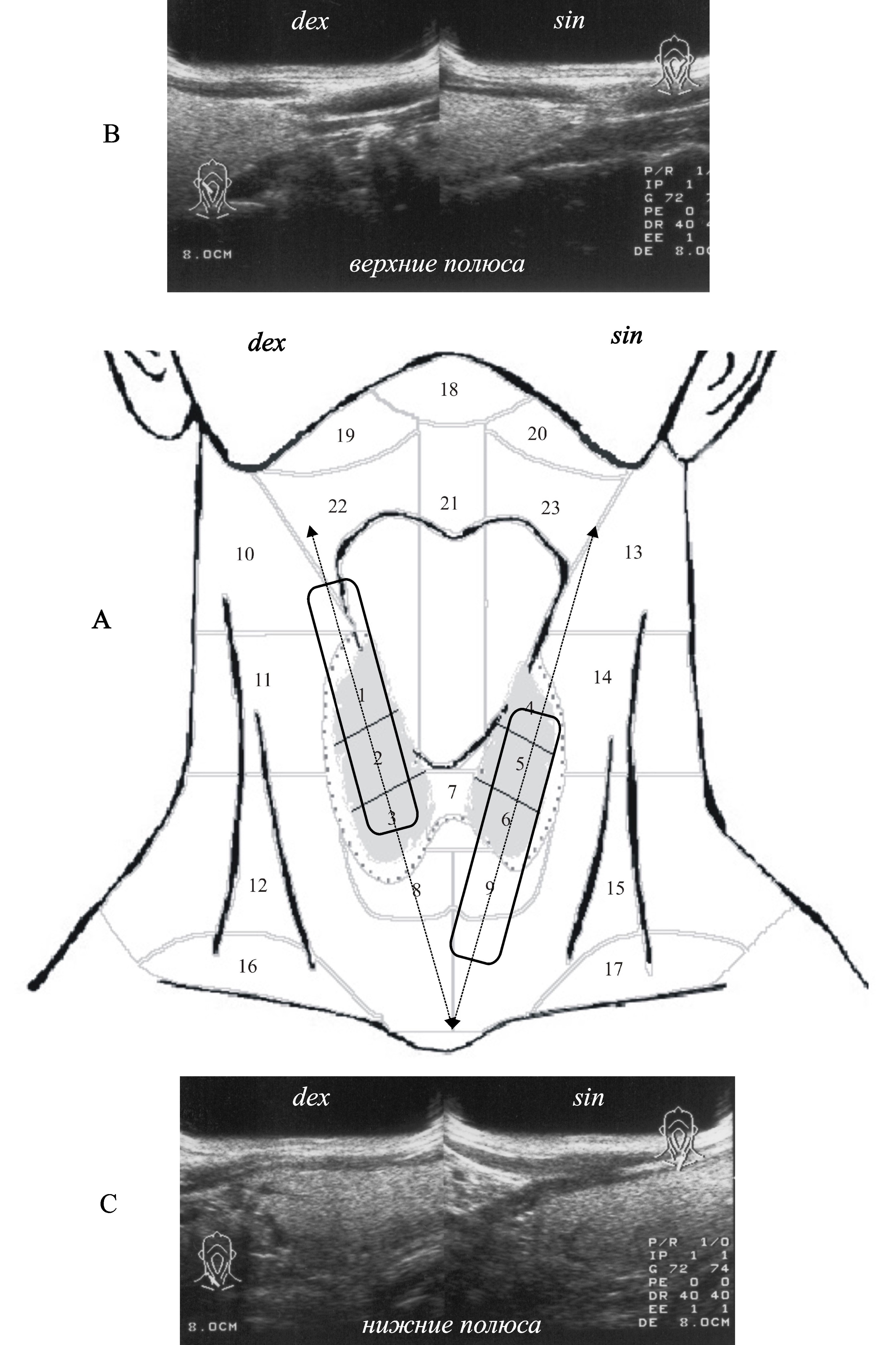 Схема щитовидной железы на узи. Паращитовидные железы на узи норма. Сегментарное строение щитовидной железы. Верхний полюс щитовидной железы. Сегменты щитовидной железы.