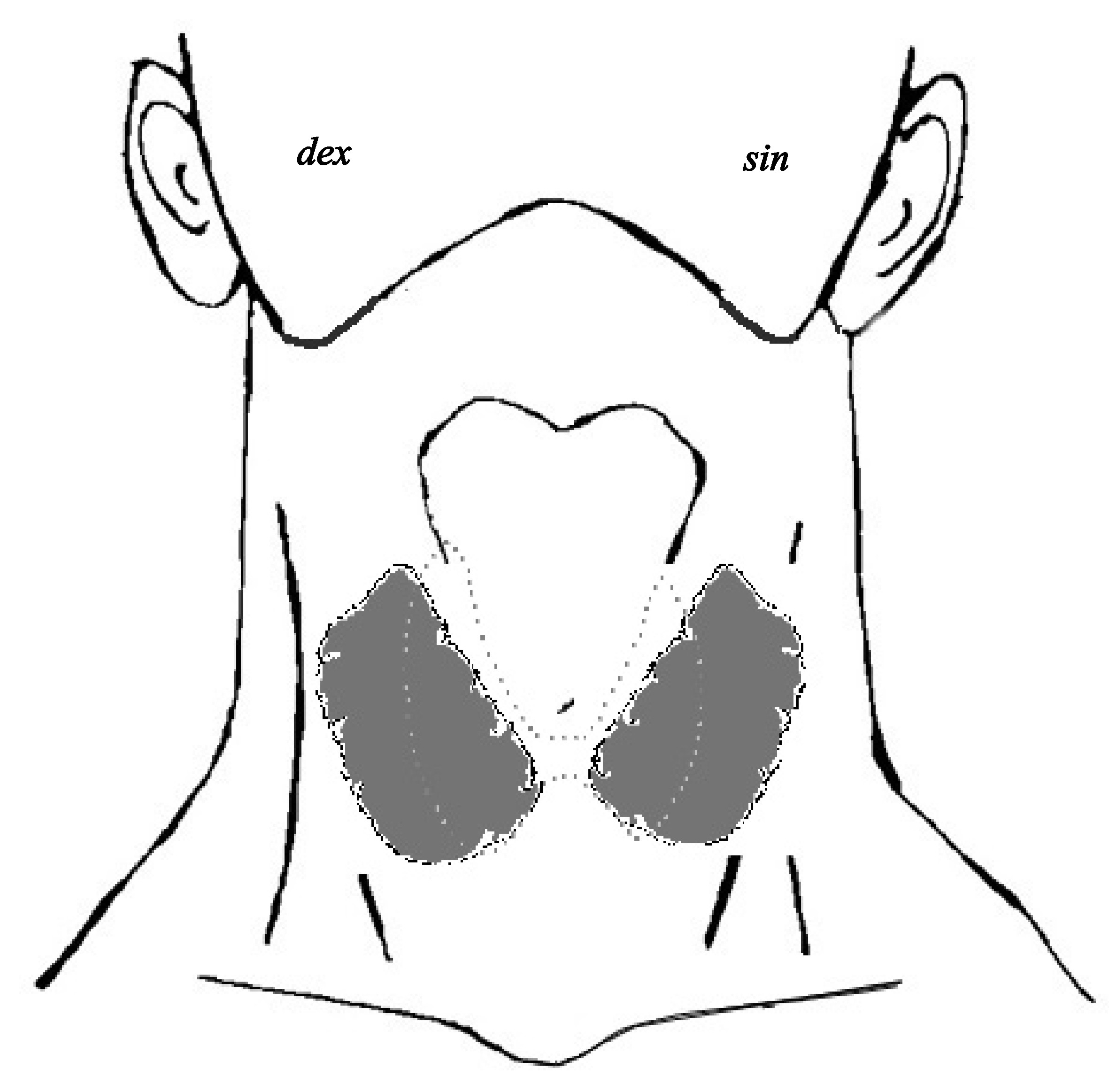 Зоб ахан. Токсический зоб щитовидной железы. Эндемический зоб экзофтальм. Диффузный эндемический зоб. Токсичный зоб щитовидной железы.