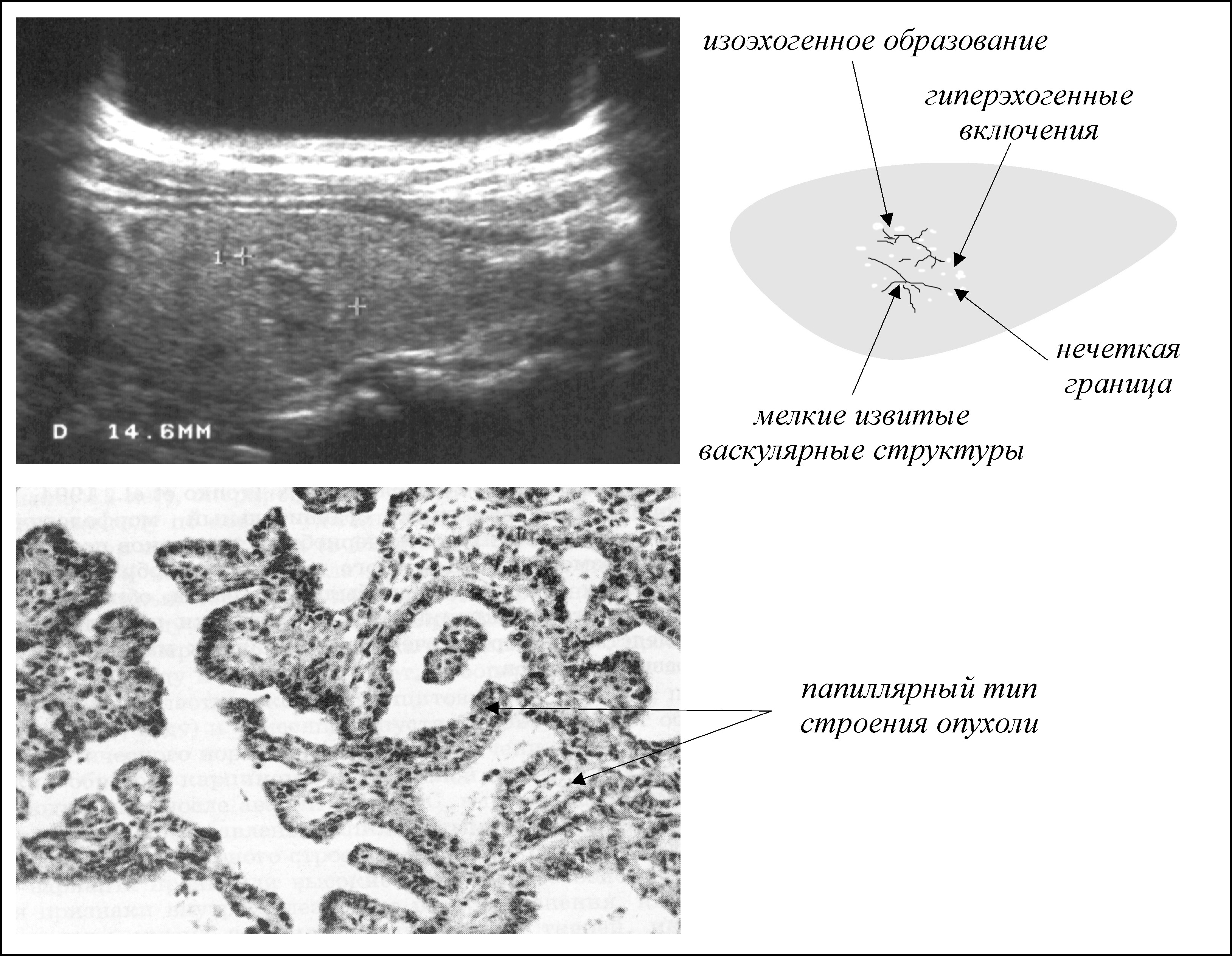 Гиперэхогенным округлым образованием. Точечные гиперэхогенные образования в щитовидной железе. Опухоль это гиперэхогенная структура. Гиперэхогенная структура в щитовидной железе. Изоэхогенное образование щитовидной железы УЗИ.
