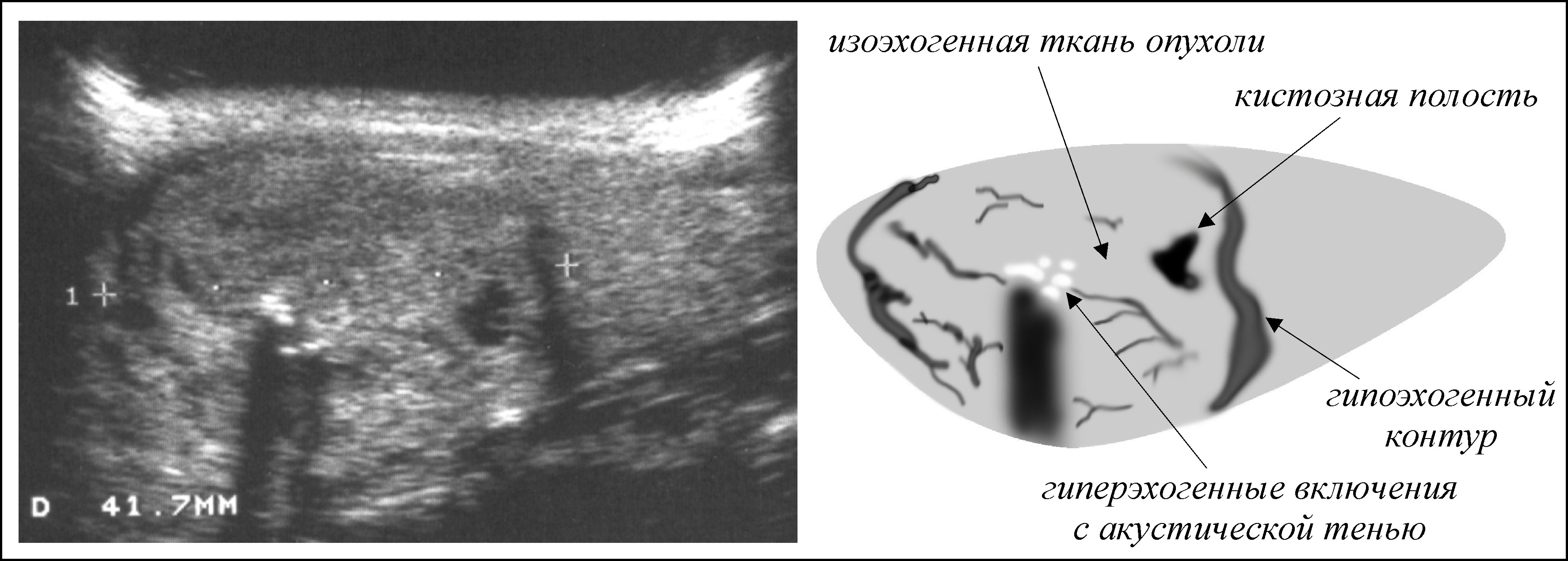 Гипоэхогенное округлое образование