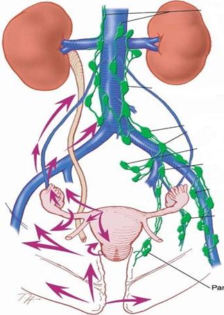 Лимфоузлы и удаление матки. Лимфатическая система малого таза. Лимфатическая система органов малого таза. Околоматочные лимфатические узлы.