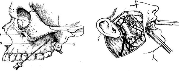 Нижний альвеолярный нерв блокада - фото презентация