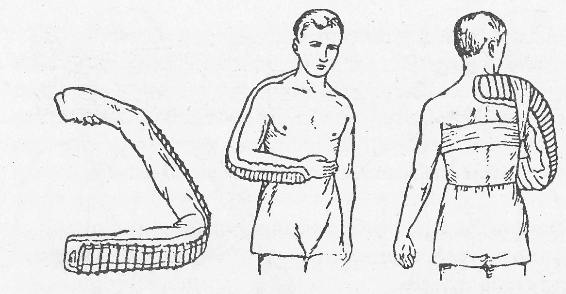 Правильно наложить шину при переломах. Шинирование при переломе костей предплечья. Шина дитерихса при переломе бедра. Правильно наложить шину при переломах. При переломе предплечья шина накладывается.