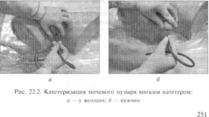 Катетеризация мочевого пузыря. Катетеризация мочевого пузыря у мужчин мягким катетером. Постановка мочевого катетера у мужчин. Катетеризация мочевого пузыря у женщин. Катетеризация мочевого пузыря у мужчин металлическим катетером.