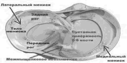 Дистрофические изменения заднего рога. Задний Рог медиального мениска анатомия. МР повреждения заднего рога медиального мениска 2. Разрыв заднего рога медиального мениска Stoller 3 a.