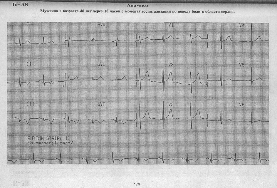 блокада правой ножки пучка гиса и инфаркт миокарда на экг. мерцательная аритмия блокада ножки пучка. блокада правой ножки пучка гиса на экг. критерии полной блокады левой ножки пучка гиса. комплекс qrs при блокаде левой ножки пучка гиса.