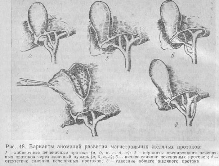 Врожденная желчного пузыря