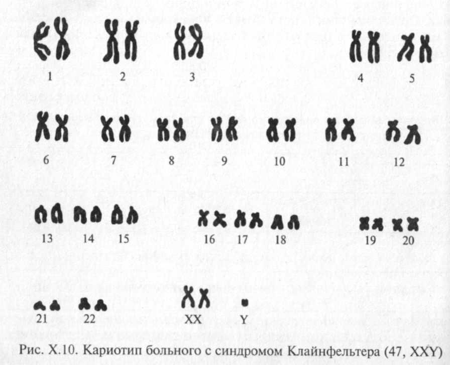 Xxy хромосома. Синдром Клайнфельтера кариотип. Хромосомная карта синдрома Клайнфельтера. Синдром Клайнфельтера кариограмма. Кариотип синдром Клайнфельтера кариотип.