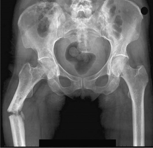 Трещина тазобедренного. Рентгенограмма перелома бедренной кости. Перелом бедренной кости рентген. Перелом бедренной кости рентген снимок. Перелом правой бедренной кости.