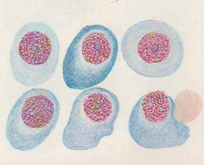 Кариопикноз это. Кариопикноз кариорексис кариолизис. Лимфоцитарный Росток. Пикнотические клетки. Клетки лимфоцитарного ростка.