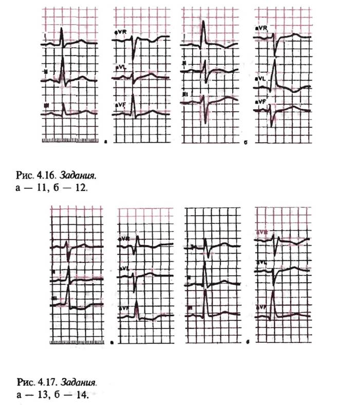 Вертикальное положение электрической оси сердца на экг. Полувертикальное положение эос. Полувертикальное положение эос. Полувертикальное положение эос. Положение эос угол альфа.