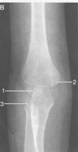 Изображение - Рентгеноанатомия локтевого сустава image072