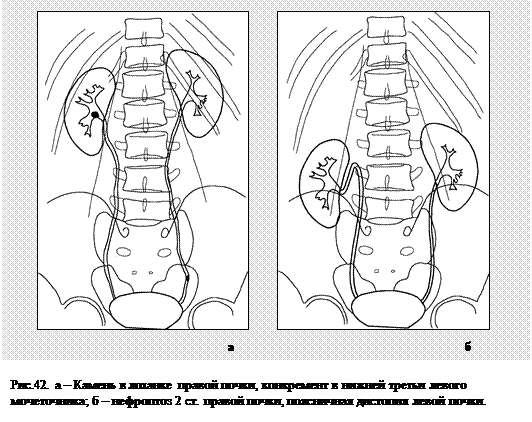 Нефроптоз спорт. Нефроптоз 1 степени рентген. Стадии нефроптоза.