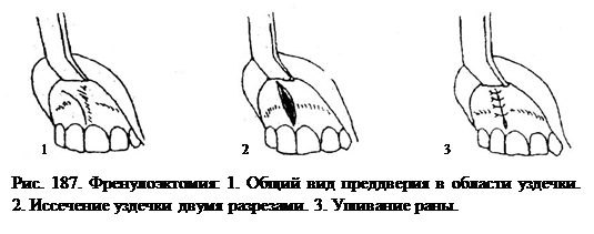 Где находится уздечка у женщин рисунок