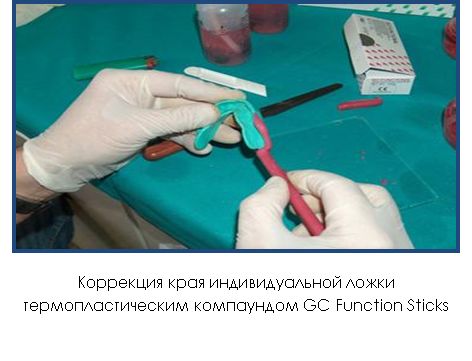 Припасовка индивидуальной ложки на верхней челюсти проводят по следующему плану