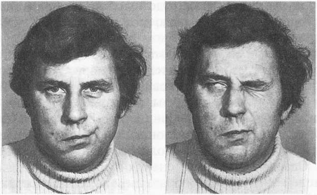 Какой врач первым описал паралич лицевого нерва - фото презентация