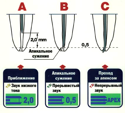 Эндодонтические моторы что это
