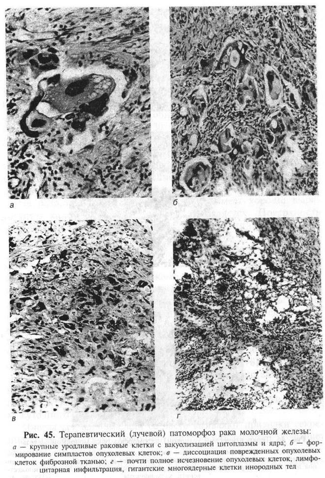протоковая аденокарцинома гистология. инфильтрирующая карцинома молочной железы гистология. метапластической карциномы молочной железы. медуллярная карцинома молочной железы гистология. экспрессия клеток.