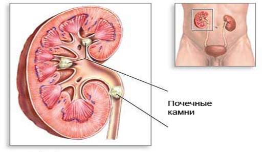 Соли в почках