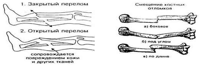 Открытый закрыть перелом