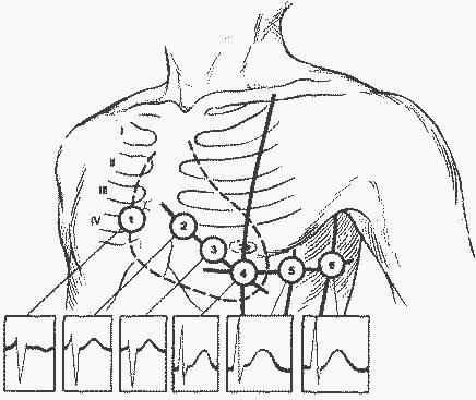 Как снимать кардиограмму
