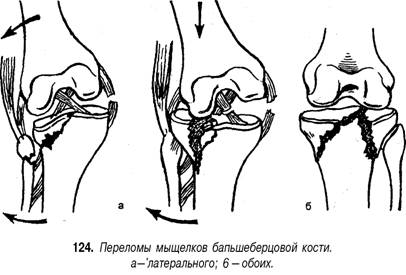 Перелом мыщелка большеберцовой кости без смещения фото Переломы межмыщелкового возвышения большеберцовой кости - Студопедия