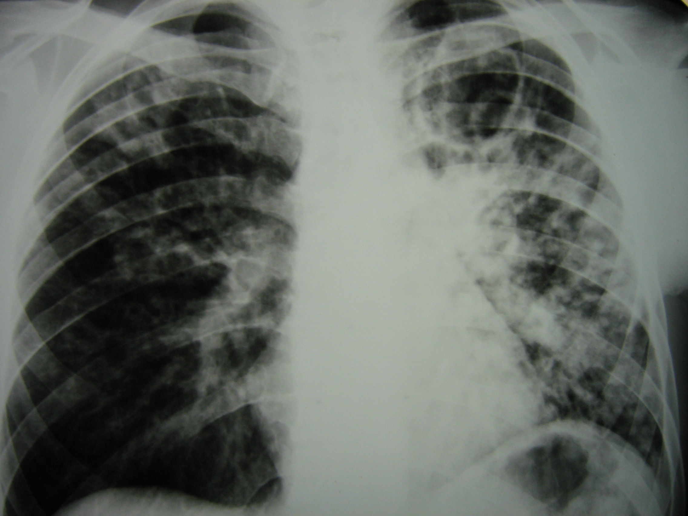 Каверна туберкулез рентген